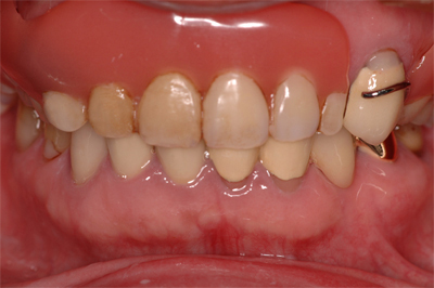 入れ歯の治療