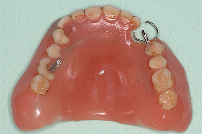 入れ歯の治療例