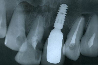 インプラント施術例