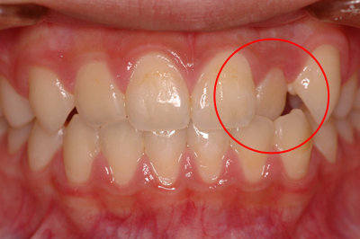 インプラント施術例