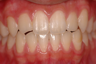 インプラント施術例